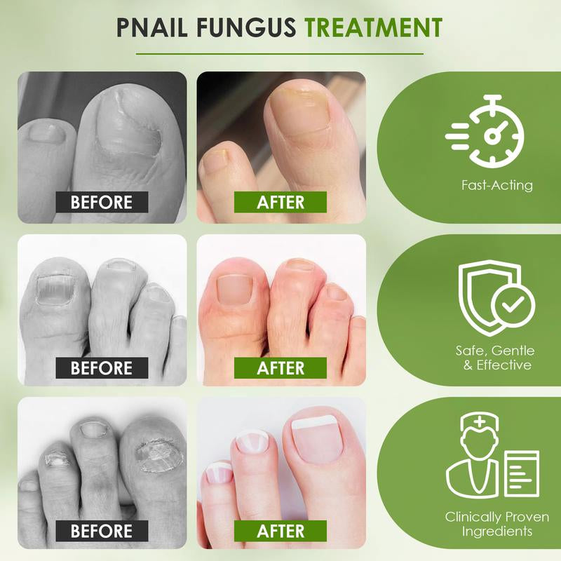 4-Pack Nail Fungus Treatment Pens – 25% Undecylenic Acid, Extra Strength Formula with Twist Pen Applicator